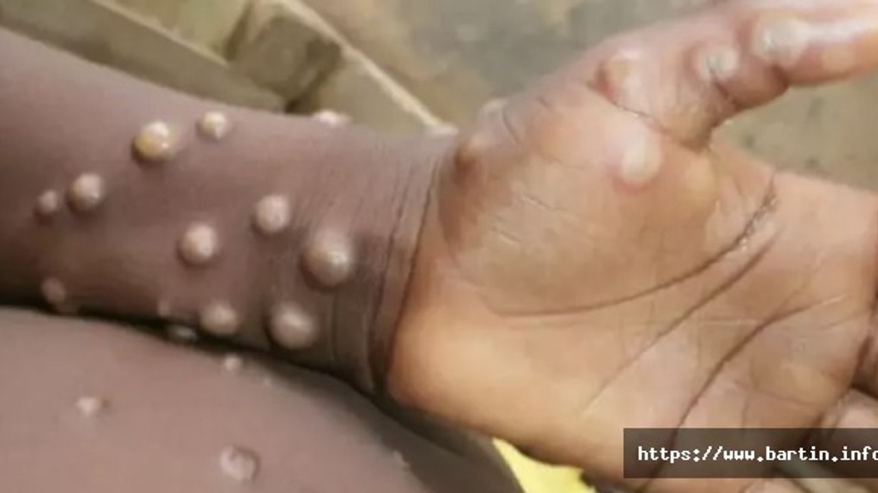 Mpox Salgını Dolayısıyla Küresel Acil Durum İlan Edildi