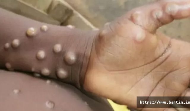 Mpox Salgını Dolayısıyla Küresel Acil Durum İlan Edildi